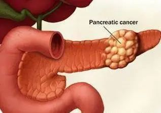 男子患胰腺炎住院从200斤瘦到105斤